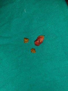 However, this carries the risk of developing stump She insisted that open cholecystectomy was performed cholecystitis when the gallbladder remnant becomes 14 years before and there was a surgical