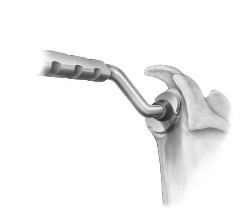 Hole If using the Cannulated Reamers, drill the 0.079 inch K-wire in the center of the glenoid (Figure 15).