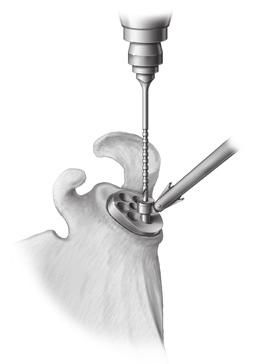 Ream the Glenoid and Drill Glenoid late