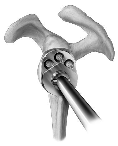 Bone Graft for Glenoid late Two options exist for placing bone graft in the glenoid plate s cage (Figure 52).