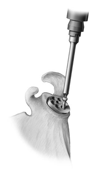 Implanting the Glenoid late Once the cage hole is drilled, the Glenoid late is attached to the Glenoid late Inserter and the Glenoid late is press-fit into position taking care to respect the correct