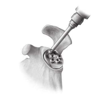 Threaded erpendicular to Glenoid late [ ] Threaded with 15-Degree Superior Tilt After all Compression Screws are tightened by hand, as deemed appropriate by the orthopaedic surgeon, the surgeon