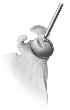 during the glenoid reaming step).