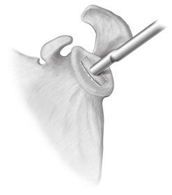 D Ream Humeral Shaft E