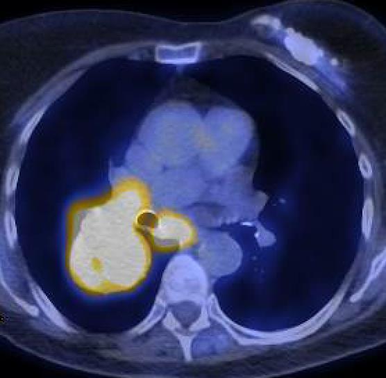 Patient Case: Advanced Recurrent SqCLC Presentation: 66-year-old woman with 50 pack per year smoking history presents with cough and fatigue (PS=1) At presentation Diagnosis: Stage IIIA NSCLC of