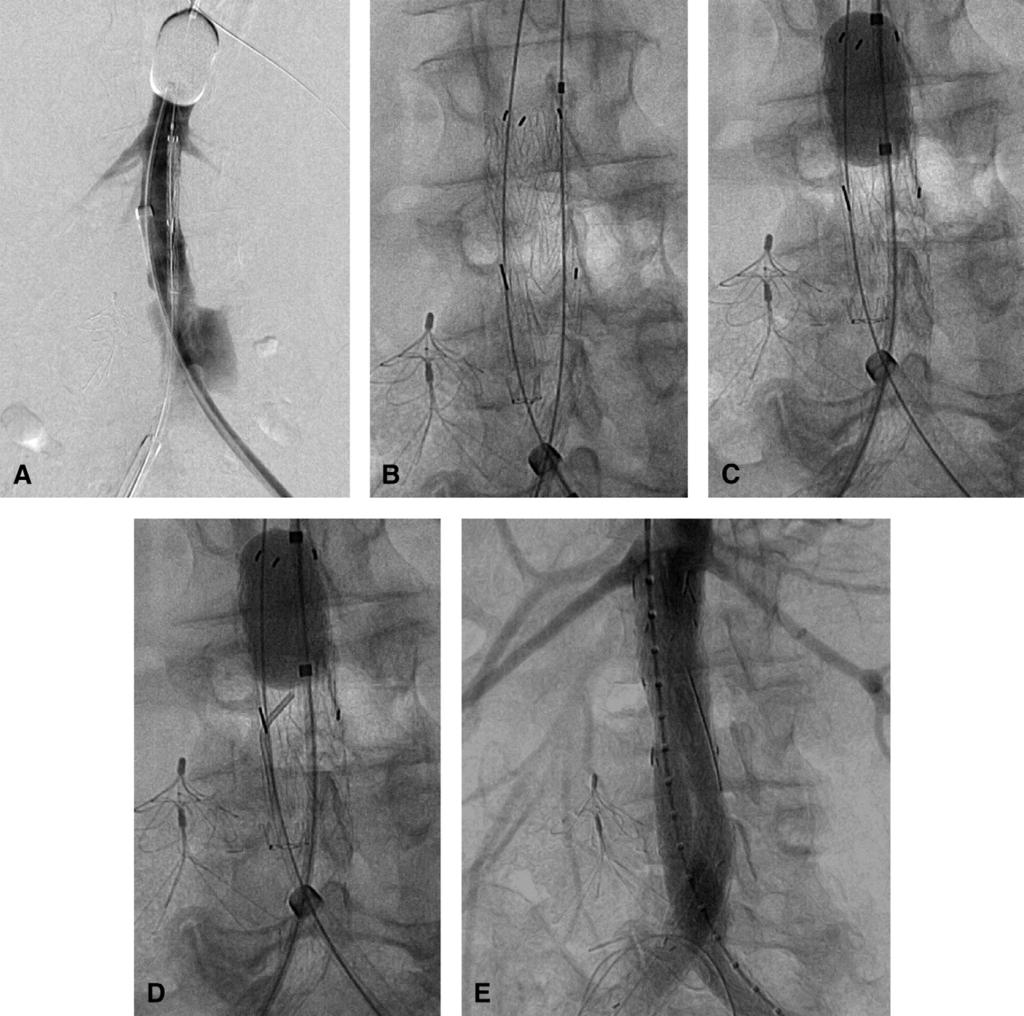 JOURNAL OF VASCULAR SURGERY Volume 52, Number 6 Mehta 1711 Fig 4. Managing the aortic occlusion balloon during stent graft deployment.