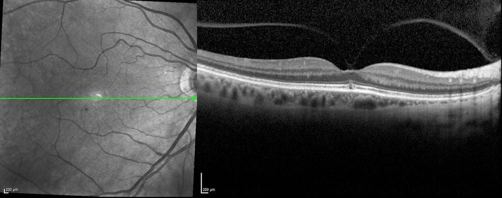lost their initial finding of vitreomacular adhesion at final examination progressed to complete posterior vitreous detachment (stage 4). One of them developed a full-thickness MH.
