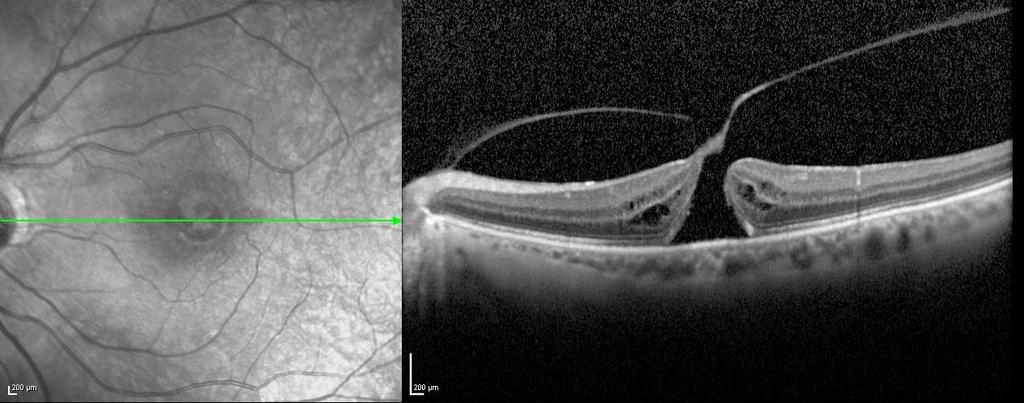 Figure 4 - Initial OCT imaging of the fellow eye of the first case previous to the development of the macular hole.