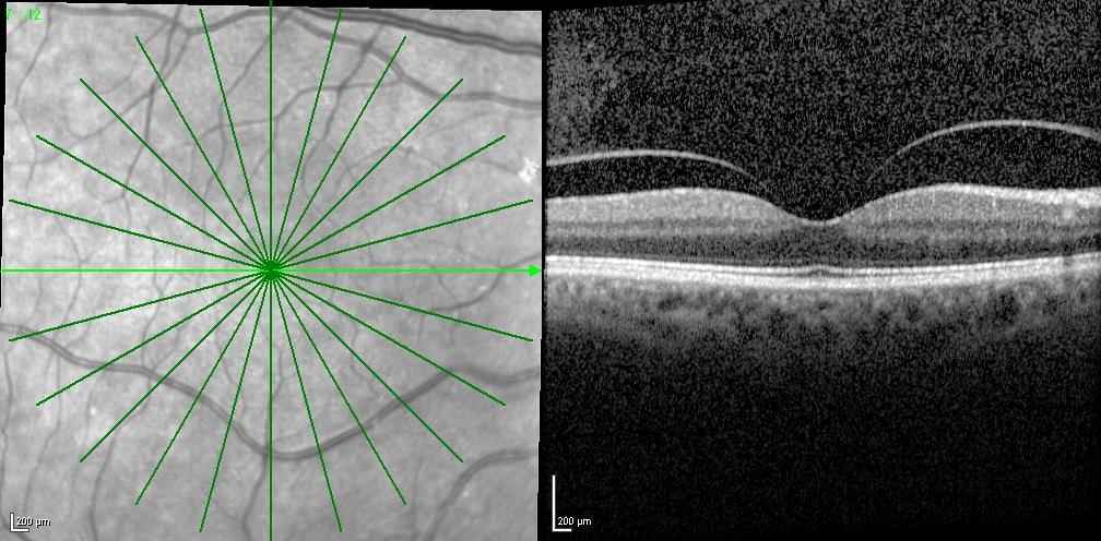 Figure 6 - Initial OCT imaging of the fellow eye of the second case previous to