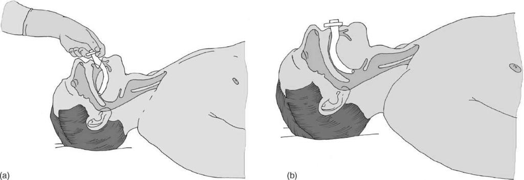 S52 J.P. Nolan et al. Figure 4.6 Insertion of oropharyngeal airway. 2005 European Resuscitation Council. the patient s incisors and the angle of the jaw (Figure 4.6).