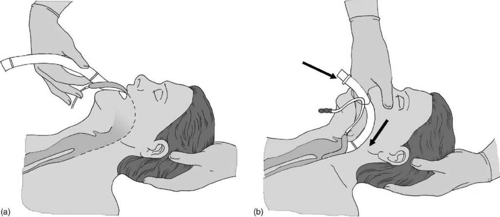 European Resuscitation Council Guidelines for Resuscitation 2005 S55 Figure 4.9 Insertion of a laryngeal mask airway. 2005 European Resuscitation Council.