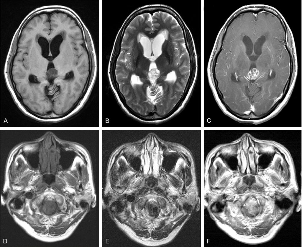 Figure 1. Brain MRI images of two cases. A: T1-weighted axial MRI image of case one. B: T2-weighted axial MRI image of case one. C: Gadolinium-enhanced T1-weighted axial MR image of case one.