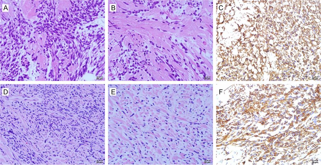 Figure 2. Histopathological and immunohistochemical images of two cases. (A & B) The tumor of case two showed a spindle cell tumor with a patternless-pattern and areas of dense collagen deposition.