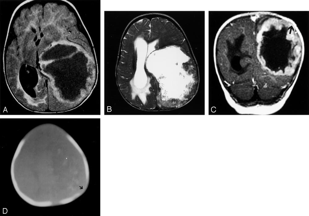 AJNR: 25, March 2004 TERATOID/RHABDOID TUMOR 477 Clinical, pathological, and imaging findings of four patients with the diagnosis of atypical teratoid/rhabdoid tumor CT and MR Imaging Findings