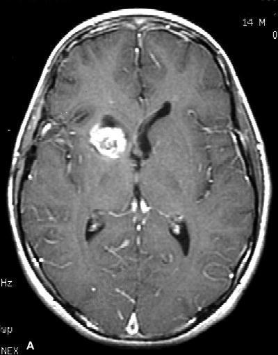anaplastic astrocytoma WHO grade 3 grade 2 plus mitoses most over 20 years old