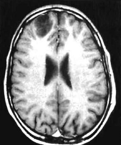 oligodendroglioma WHO grade 2 associated with seizures #1 site: frontal