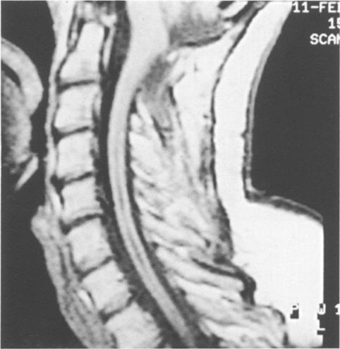 Act Neurochir (Wien)(1995) 134:93-99 :Act. _ N urochlrurgc 9 Springer-Verlg t995 Printed in Austri Mgnetic Resonnce Imging (MRI) in Syringomyeli H. L. J.