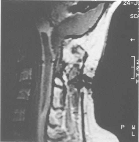 The size of the cysts is very vrile nd cn rnge from smll focl cyst, s in post-trumtic syringomyeli, to cyst which stretches from the crnio-cervicl trnsition to the conus.