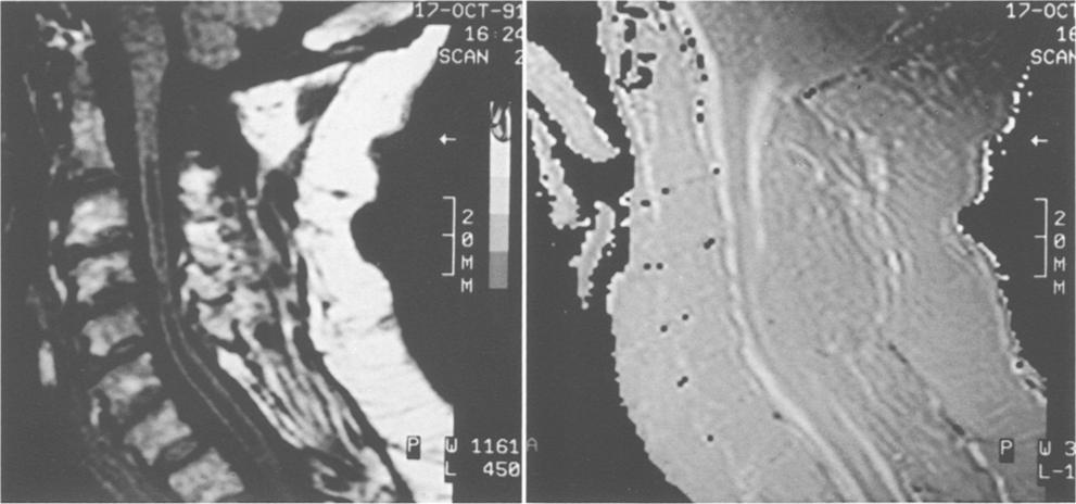 96 H.L.J. Tnghe: Mgnetic Resonnce Imging (MRI) in Syringomyeli it Fig. 8. () Equl signl intensity in syrinx cyst nd djcent surchnoidl spce (TIW imge).