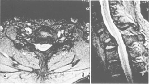 98 H.L.J. Tnghe: Mgnetic Resonnce Imging (MRI) in Syringomyeli Fig. 12. Myelomlci in ptient with prplegi fter cervicl trum with terdrop frcture.