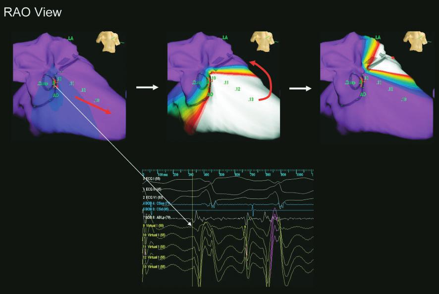 Narita S Noncontact mapping to idiopathic VT from LCC by the NCM was performed according to an established method reported by other researchers; the details of NCM have been described elsewhere.