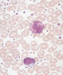 Erythrocytosis ( red blood cells) V