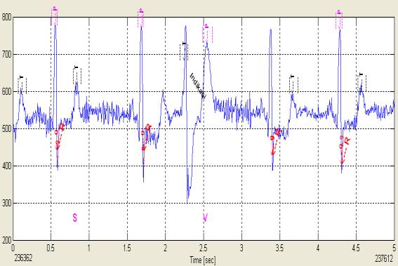 can be seen the identification of a component of T. Figure 3. Wavelet DeGePVC testing onsecond Lead with noise Table. The sensitivity result of detection of the PVC component with DeGePVC Figure 5.
