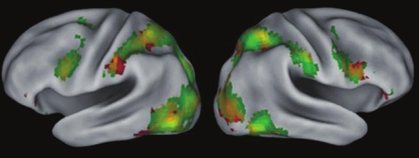 2552 Bianchi-Demicheli et al. Figure 2 Surface rendering of NHSDD (green) and HSDD (red) group average brain activations for the Erotic stimuli > Non-Erotic stimuli contrast.