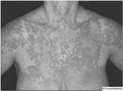 Urticaria Classic for IgE reactions Usually occurs immediately Very pruritic