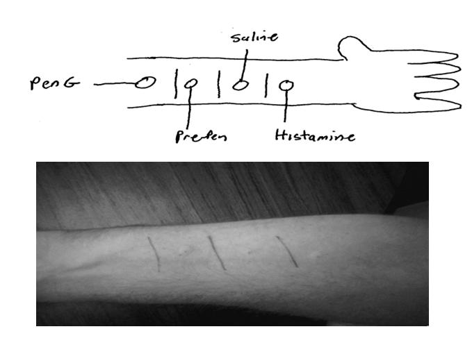 Skin Testing Procedure No histamine blockers within 24 hrs Scratch Test Positive Negative Indeterminate Intradermal Test Record results Dose challenge Procedure for Penicillin Skin Testing I.