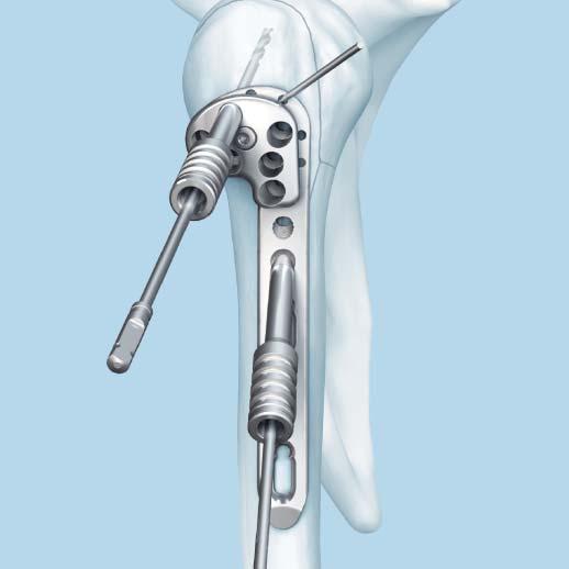 Surgical Technique 6 Position plate on bone Instruments 312.648 2.8 mm Threaded Drill Guide 324.214 2.8 mm Drill Bit, 100 mm calibration Optional instruments 292.71 1.