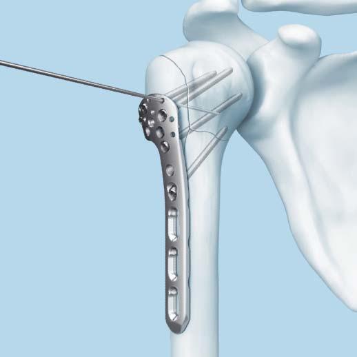 Surgical Technique 7. Insert locking screw into plate head continued Stop when increased resistance from the subchondral bone is felt.