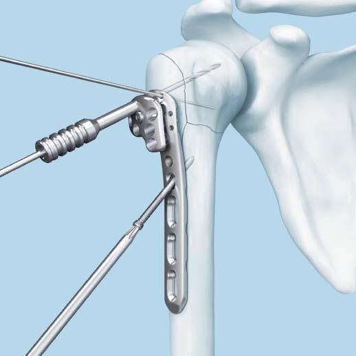 Note: Since it may not always be possible to feel this resistance from the subchondral bone, and the drill bit represents the final position of the locking screw, the use of image intensification is