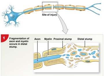 Injury Repair & Regeneration of Nervous Tissue In PNS: If the cell body of the neuron