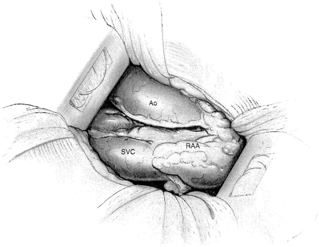 The fat overlying the anterior mediastinum is mobilized, and an incision is made into the pericardium, exposing the root of the aorta and the junction of the superior vena cava and right atrial