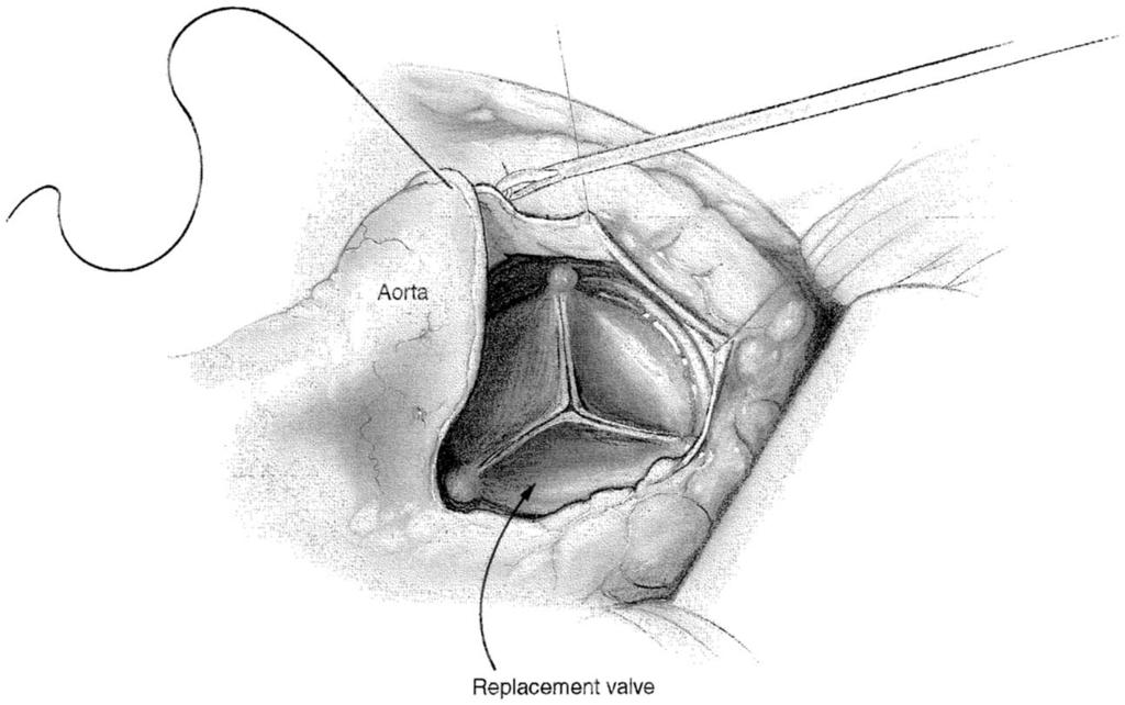 Typically the lateral inferior portion of the incision is closed with interrupted figure eight sutures, whereas the anterior part of the incision is closed ~dth two running layers of Prolene.