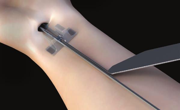 Dilate the carpal tunnel space with the sequential dilators, aiming toward the third web