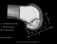 and outside femoral footprint Above the ridge Lim et al. Clin Orthop Surg 2012 Driscoll, Noble et al.