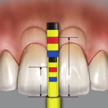 PAPILLA TIP IN USE: Hold the CL Gauge using a pen grasp with the Papilla tip facing up. Rest the incisal stop against the interproximal incisal edge of the tooth to be measured.