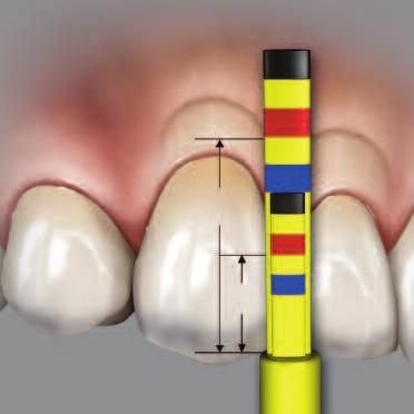PAPILLA TIP IN USE CONTINUED: Interproximal measurements between lateral incisor and canine should be at the upper margin of the yellow band (located between the red and blue bands). 9.