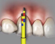 the rotated teeth. The instrument is used to measure the width and length of the maxillary anterior teeth.