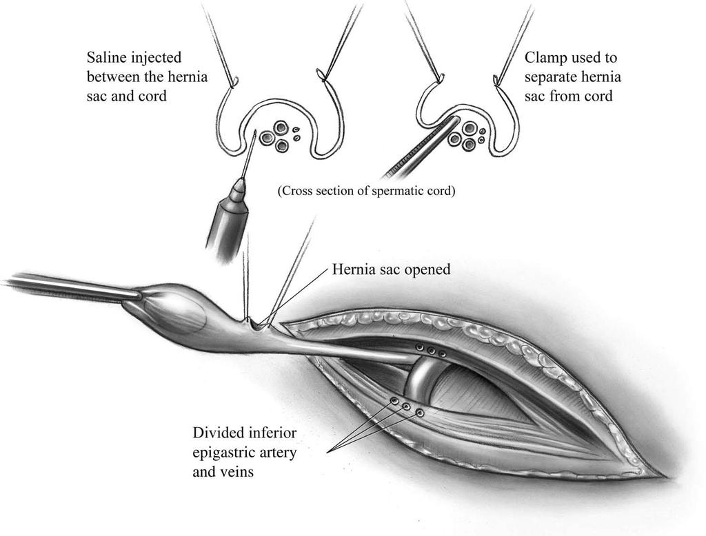 Undescended Testes/Orchiopexy 273 4 The cremaster muscle is dissected from the spermatic vessels and the vas deferens is mobilized to the level of the internal ring.
