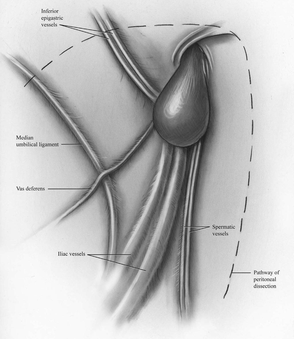 Undescended Testes/Orchiopexy 277 8 The gubernacular attachment is grasped and transected to begin mobilization of the testis.