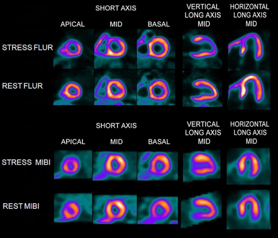 Computed Tomography Myocardial Perfusion Imaging for Detection of