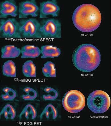 THE BEAUTY AND DAMNATION OF MOLECULAR IMAGING IN NUCLEAR CARDIOLOGY Bossone, E., et al.
