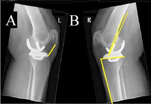 6 S. S. A. Miettinen et al. Table 4 UKA revisions. n Fig. 3. Lateral radiography of UKA. A) Measurements of the distance from the tip of the patella to the tibia plate are shown.