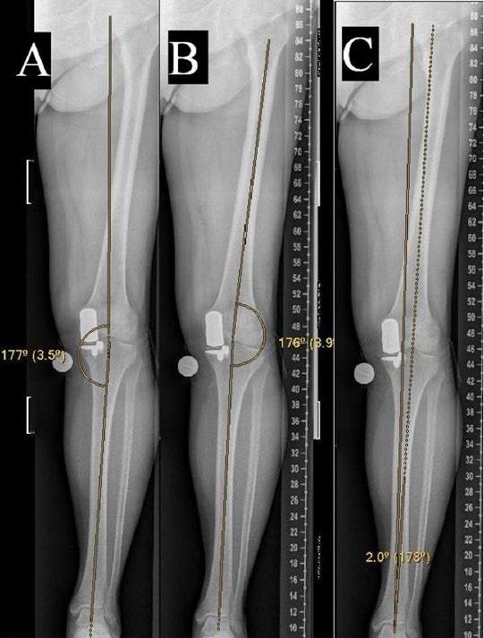 Anteroposterior radiography showing measurements of A) the mechanical axis, B) the anatomical axis, and C) the Harris angle.