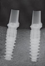 The torque necessary to insert different implants designs cannot be directly compared.
