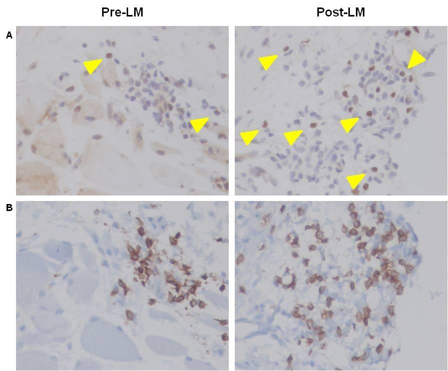 Figure 16. Immune infiltrates in pre- and post-vaccination mesothelioma biopsies with a Listeria vaccine targeting mesothelin.