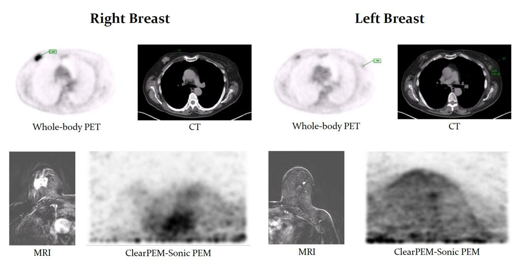 First clinical results Bilateral Breast Cancer B.
